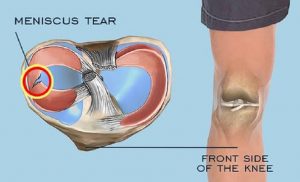 Meniscus Tear – Dr Anjan A