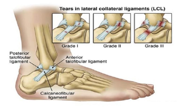 Ankle Sprain - Dr. Anjan's Orthopaedic Center