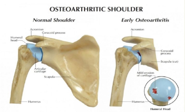 Shoulder Labral Tear – Dr Anjan A